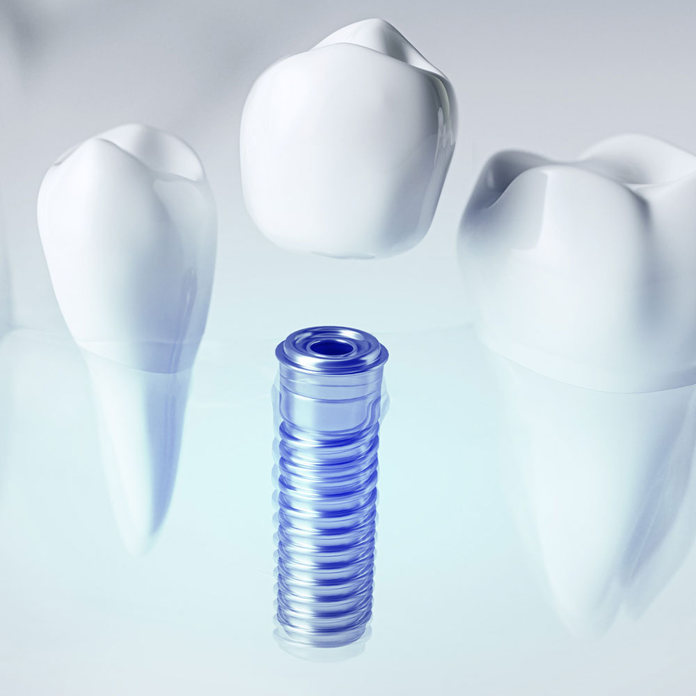 Fogászati implantátumok