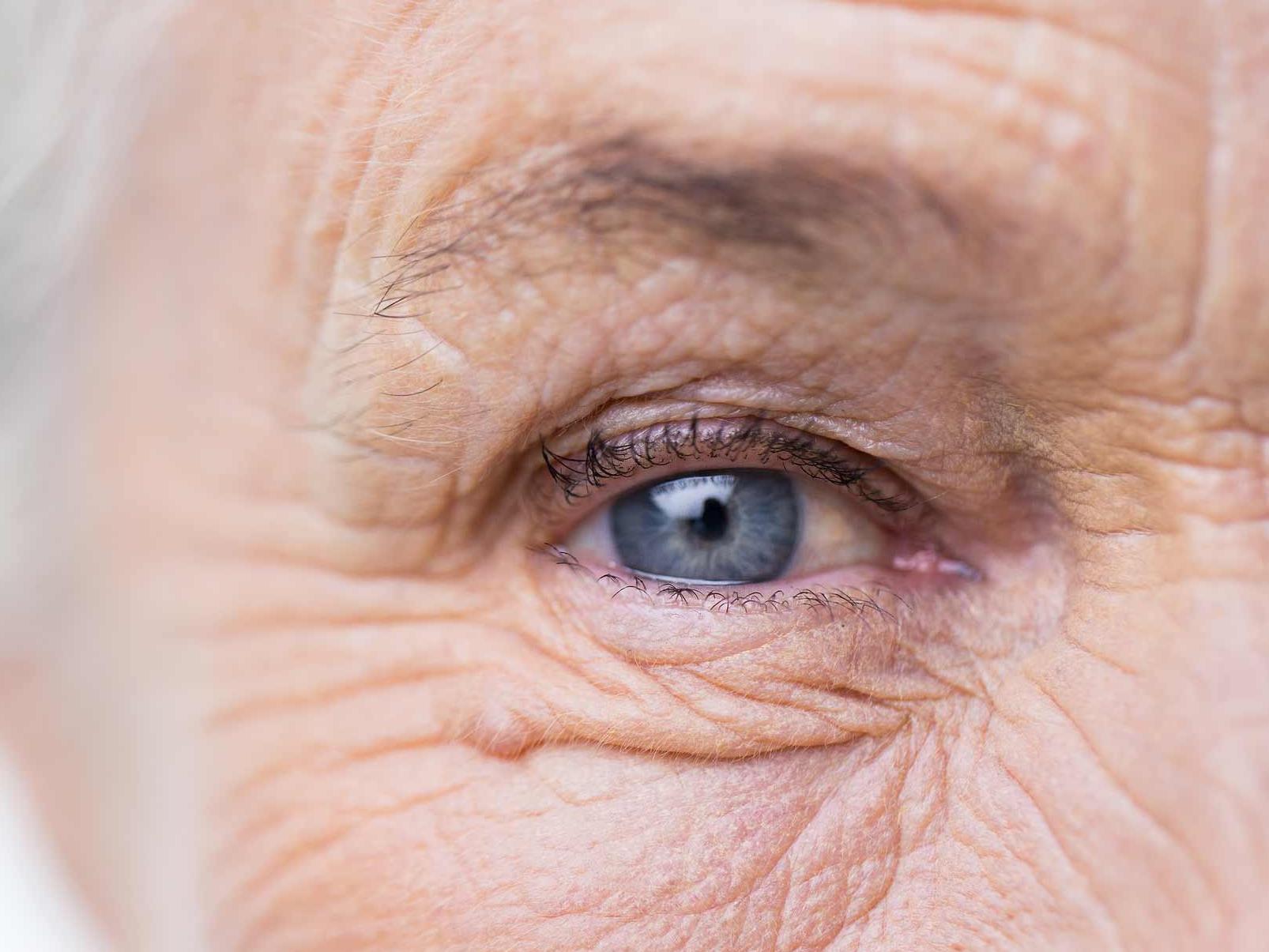 A kép egy károsodott szem közeli képét mutatja, illusztrálva a szemkörnyék egészségét fenyegető potenciális veszélyeket. 