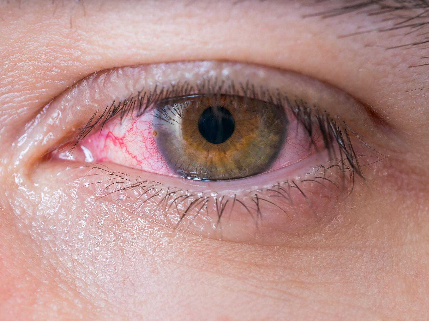 A kép egy károsodott szem közeli képét mutatja, illusztrálva a szem egészségét fenyegető potenciális veszélyeket. 