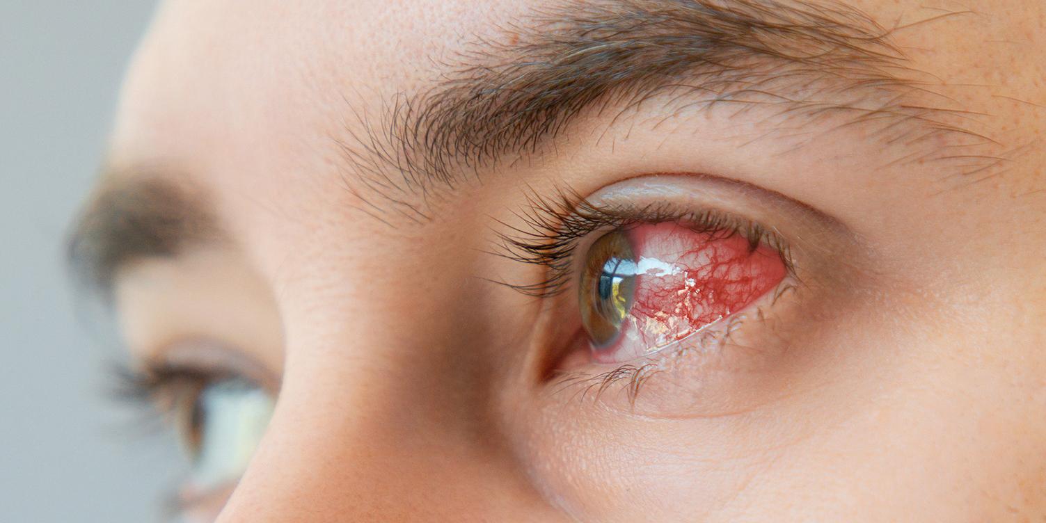 A szaruhártya-gyulladás (keratitis)