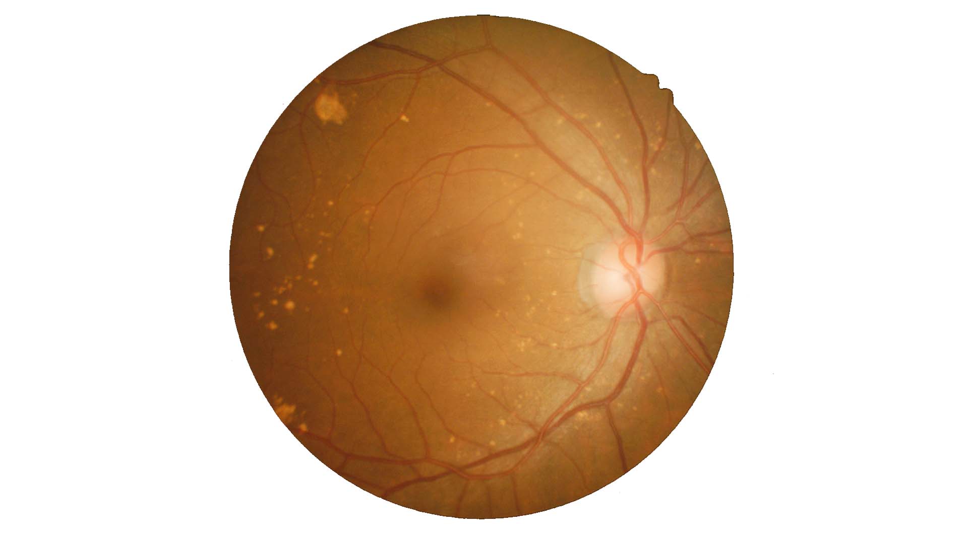 Retinasérülés