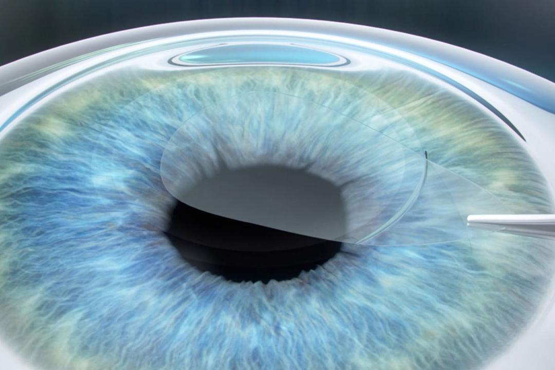 A Carl Zeiss Meditec új, kíméletes ReLEx™ SMILE kezelési módszere forradalmasítja a lézeres kezelést