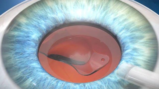 IOL behelyezése