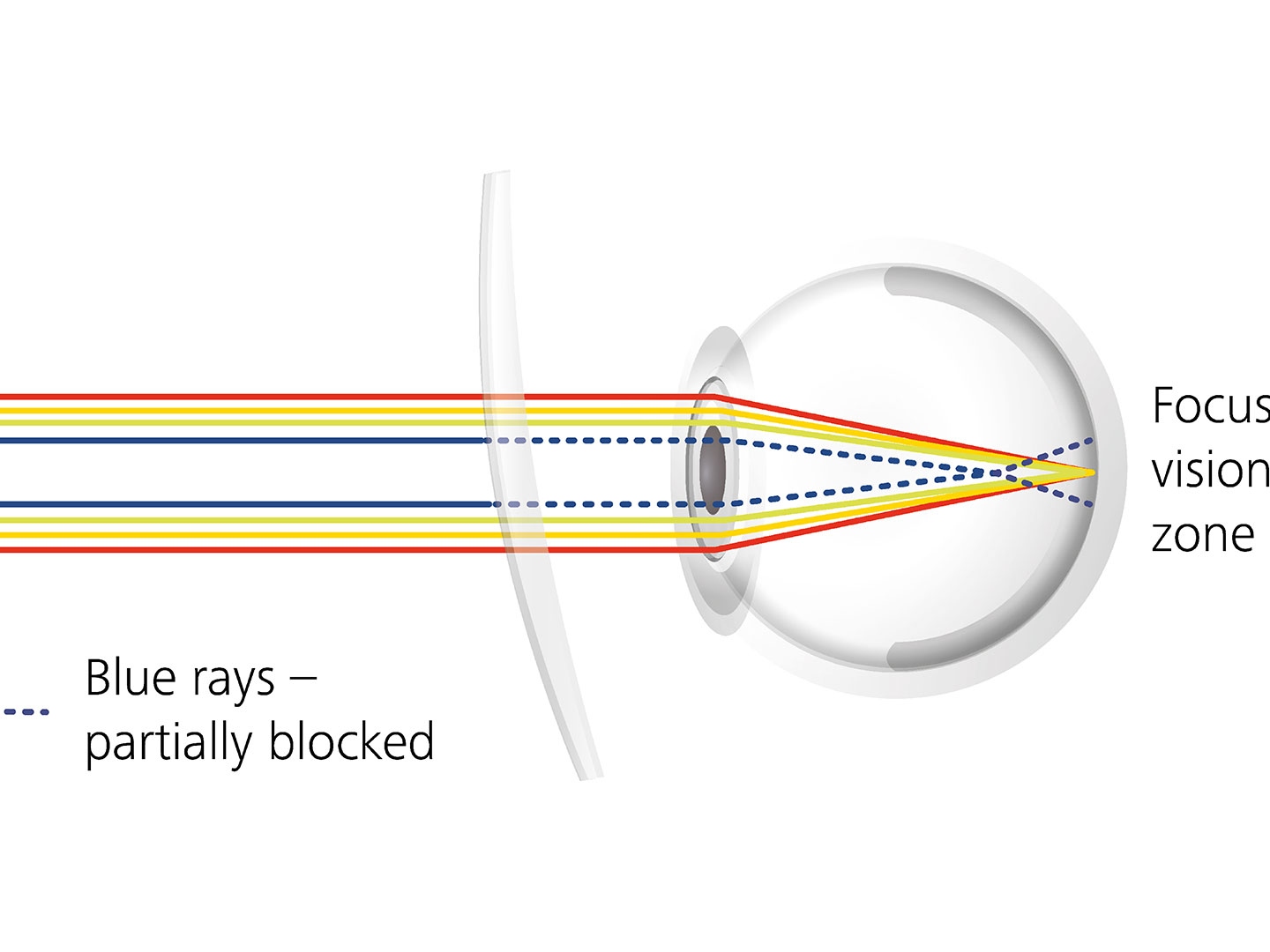 Annak szemléltetése, hogy a szemüveglencse-rétegek hogyan csökkenthetik a tükröződést a kék fénysugarak részleges kiszűrésével 